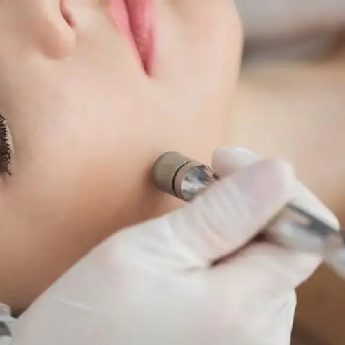 Close-up of a person receiving a microdermabrasion treatment on the cheek, performed by a professional with a tool, focusing on skin care and beauty.